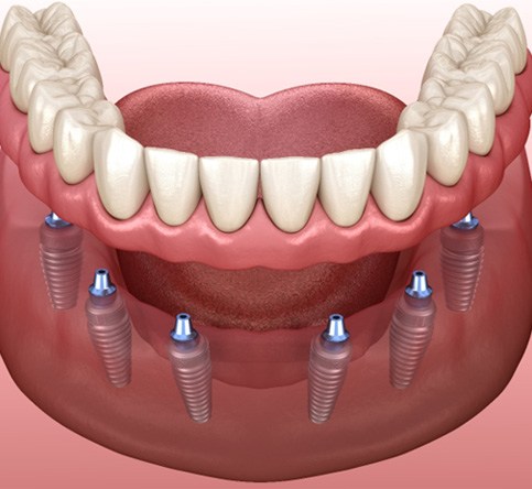 Illustration of implant denture in Westchase being attached to six dental implants