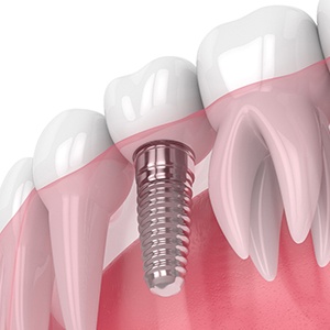 3D rendering of dental implant in Westchase