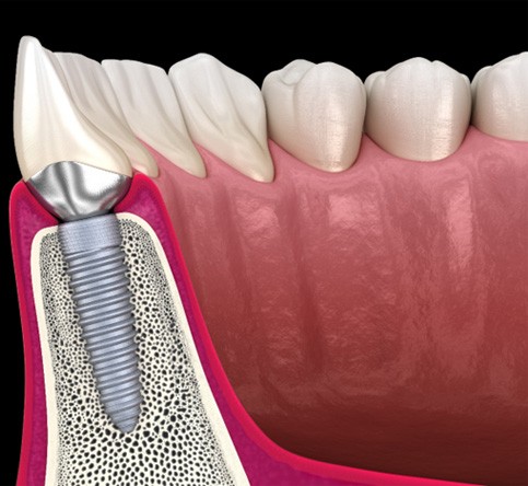 Side-view of traditional dental implant in lower dental arch