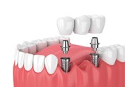 an illustration of implant dental bridges in Westchase