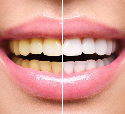 Smile before and after opalescence teeth whitening