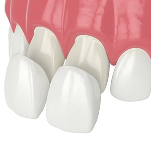 Porcelain veneers in Westchase, FL being placed on front teeth