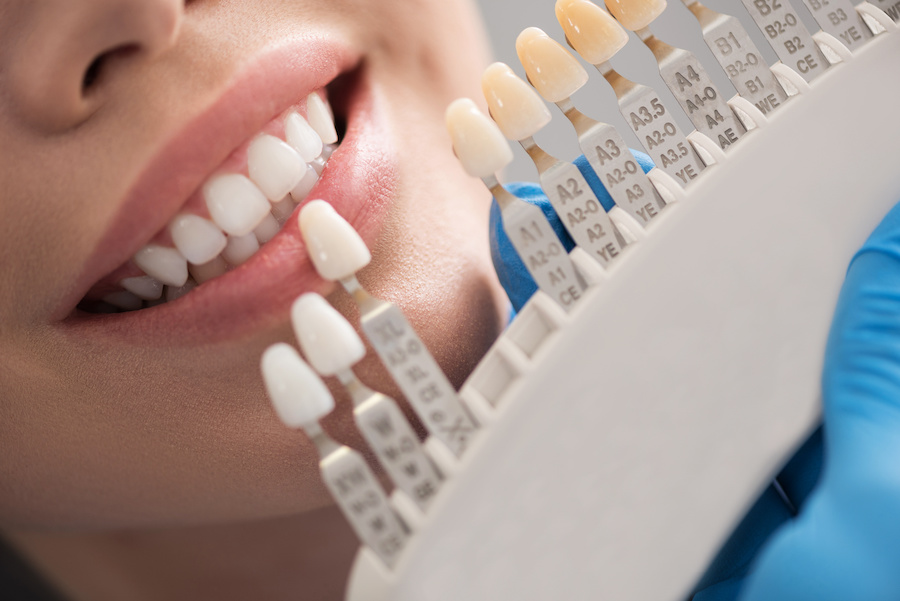 close-up of smiling teeth with a color matching chart for dental procedure 