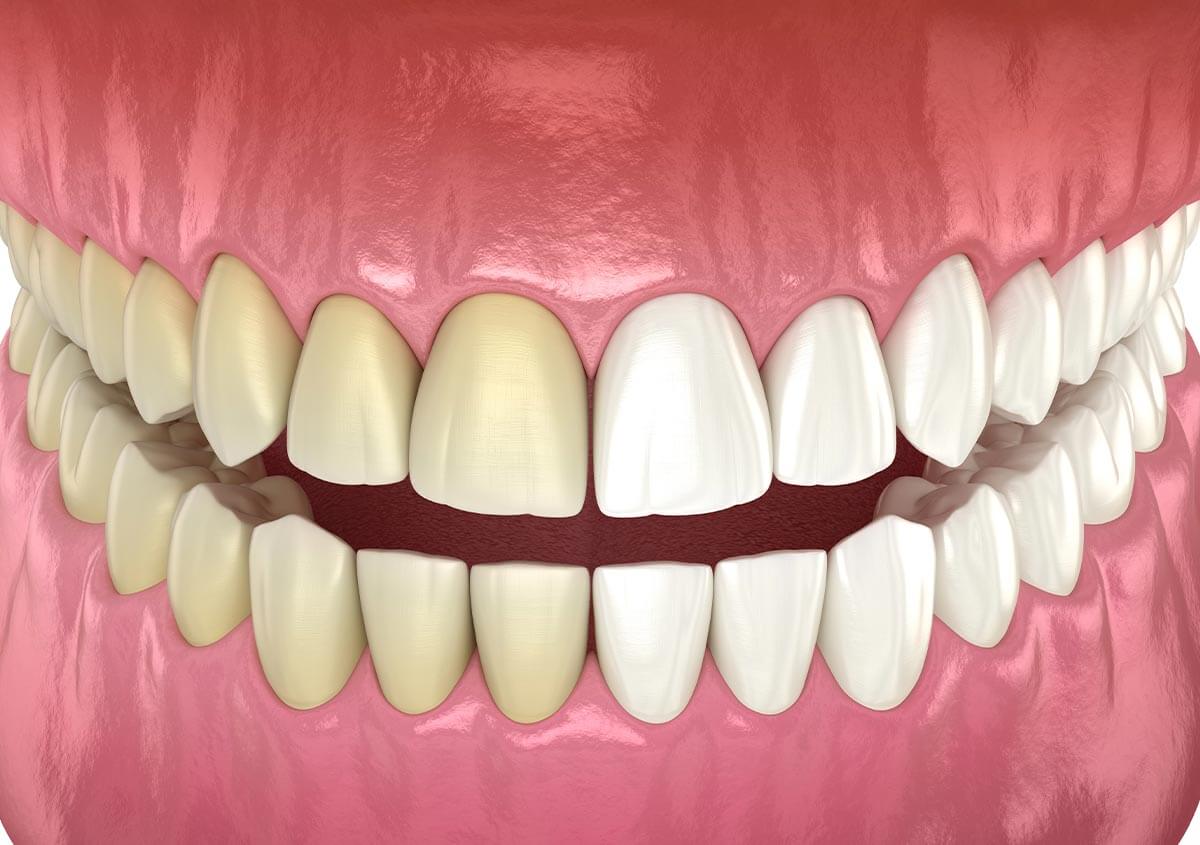 Your guide to professional teeth whitening service with a dentist at Happy Smiles
